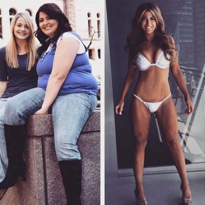 Девушка, похудевшая на 60 кг, гордится растяжками, оставшимися от «толстой» жизни