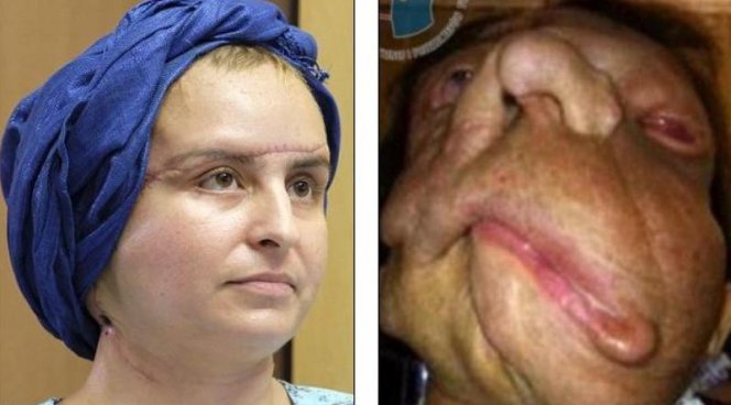 Через три года после пересадки лица женщина стала выглядеть нормально